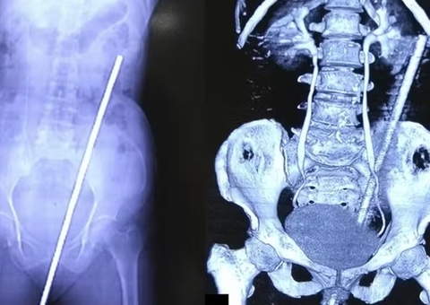 Mulher escorrega e fica com ferro de 60 centímetros no reto