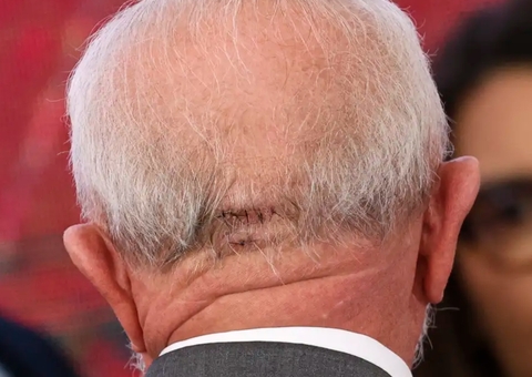 Com cicatriz na cabeça, Lula participa de 1º evento após acidente doméstico