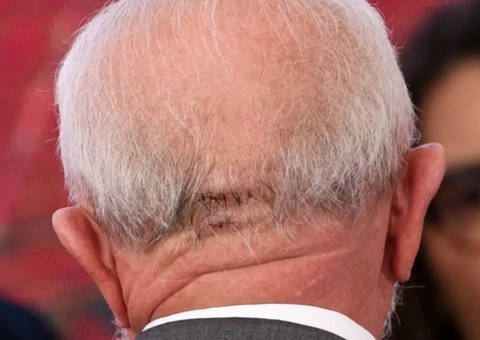 Lula volta a hospital para novos exames 12 dias após acidente doméstico