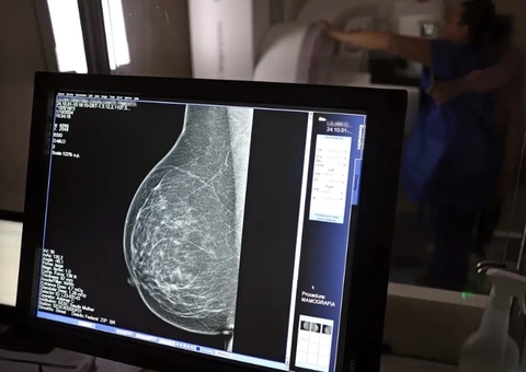 Mais de 77 mil mulheres esperam por mamografia no SUS