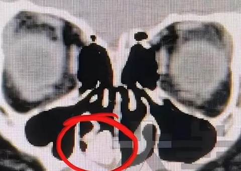 Menino descobre parafuso no nariz após 2 anos sentindo cheiro de ferrugem