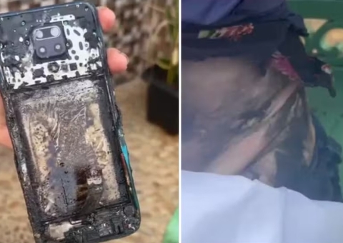 Técnica de enfermagem sofre queimaduras após celular pegar fogo em sua cintura