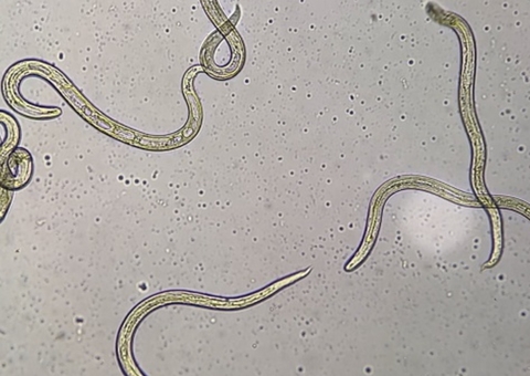 Mulher descobre parasita no cérebro após achar que dor de cabeça era por ‘jet lag’