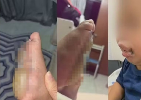 Creche é investigada após criança sofrer queimaduras de 2º grau nos pés; mães denunciam