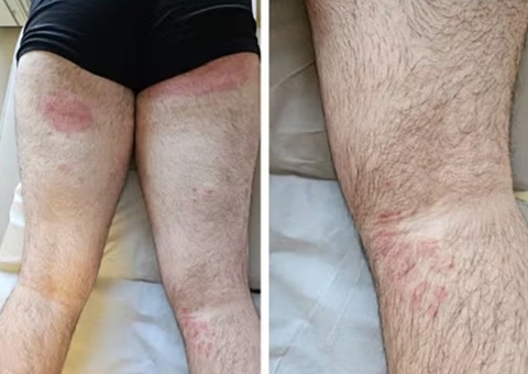 Brasil registra primeiro caso de fungo super-resistente em São Paulo