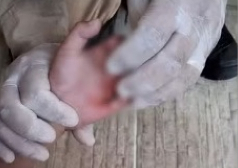 Criança é sedada para remover mão presa em piscina de Manaus