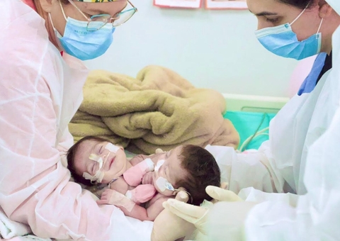 Gêmeas Siamesas de Manaus unidas pelo tórax e abdômen são separadas com sucesso