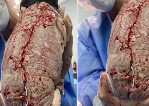 Contraceptivo falha e bebê nasce com DIU acoplado no corpo