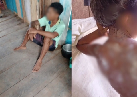 Padrasto é preso suspeito de jogar mingau quente em enteada em Autazes