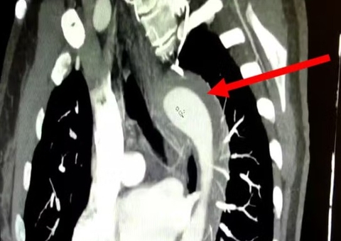Caso raro: Mulher rompe aorta durante relação sexual