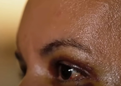 Mulher que teve rosto desfigurado com 61 socos manda recado para agressor: 'Sobrevivi'