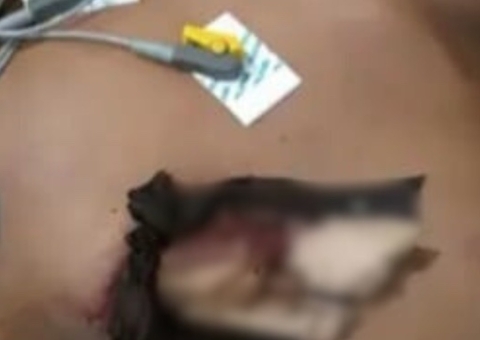 Jovem sofre perfuração no tórax durante corte de árvore em Barcelos