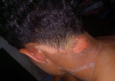 Adolescente joga água quente em criança de 9 anos e revolta população em Jutaí