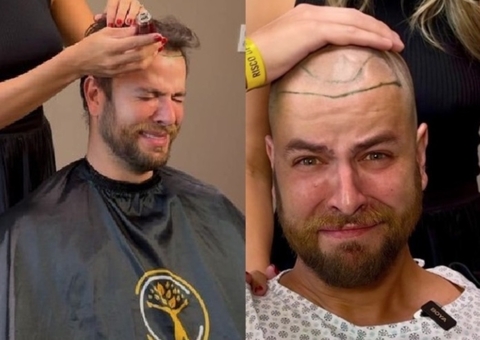 Veja o antes e depois do ex-BBB Gustavo Marsengo após transplante capilar 