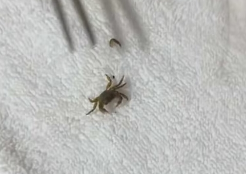 Caranguejo é retirado de dentro da orelha de criança após dia de praia