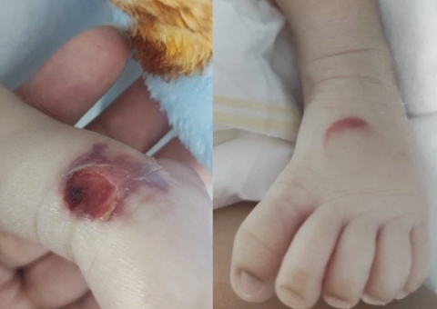 Família denuncia queimaduras em bebê prematuro na Maternidade Balbina Mestrinho