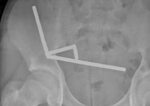 Adolescente engole quase 200 ímãs e tem parte do intestino removida