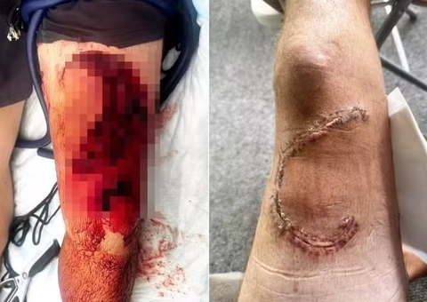 Pescador tenta salvar tubarão e acaba sendo mordido por ele no Havaí