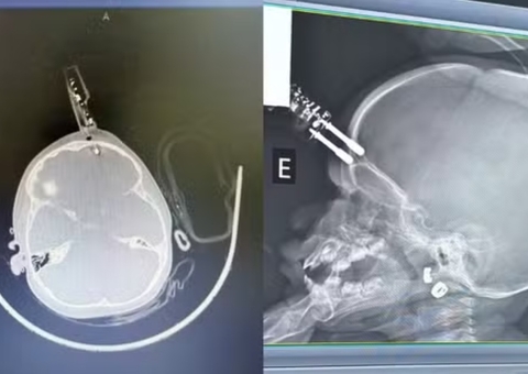 Bebê de 1 ano cai da cama e fica com carregador cravado na testa em MG