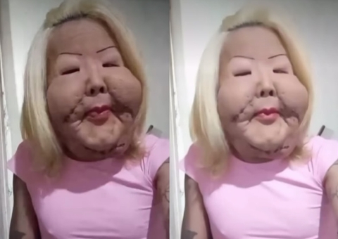 Juju do Pix relata complicação após cirurgia para retirar óleo mineral do rosto