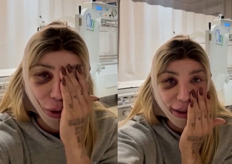 Maya Massafera passa por nova cirurgia no rosto e surge com olho roxo