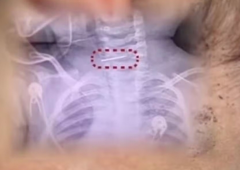 Mulher fere bebê 600 vezes com agulha na China como forma de "punição" 