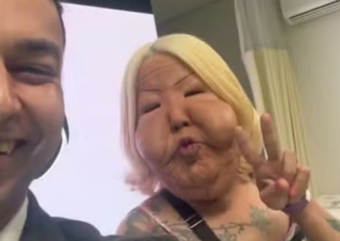 'Juju do Pix' passa por cirurgia para remover óleo que deformou seu rosto; veja antes e depois