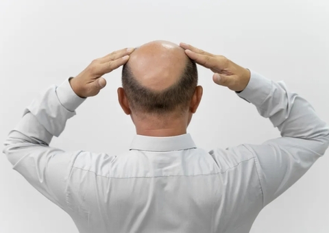 Minoxidil funciona? Veja origem do tratamento para queda de cabelo e como usar