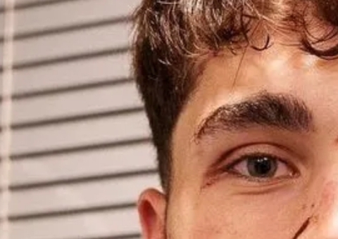 Promessa do Barcelona fica com rosto 'desfigurado' após jogo da Champions