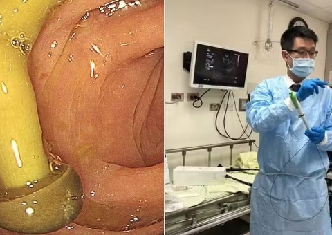 Médico encontra cogumelo crescendo em intestino de paciente