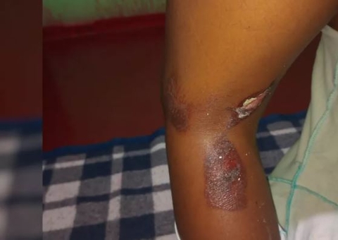 Mãe é suspeita de queimar filha porque criança estaria 'comendo demais'