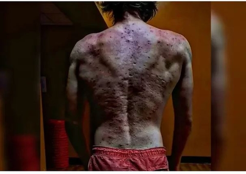 Homem fica com costas deformadas por espinhas após injetar anabolizantes