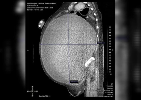 Paciente que acreditava estar obesa tira 5 quilos de cisto do ovário