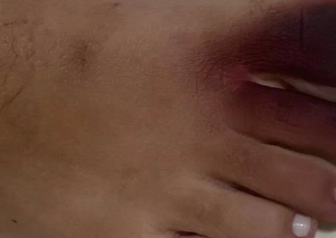 Mulher fica com pé roxo e unha amarela após contato com piolho-de-cobra