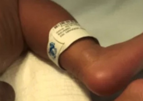 Em Fortaleza, bebê nasce com cauda e bola na ponta; veja fotos