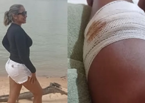 Mulher tem perna dilacerada após ataque de piranha