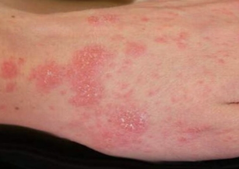 Casos de sarna humana voltam a surgir no Brasil; saiba tudo sobre a doença