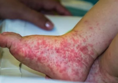 Surto de síndrome 'mão-pé-boca' em crianças acende alerta; conheça sintomas
