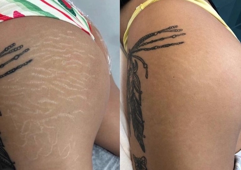 5 coisas que a fisioterapia dermatofuncional faz e você não sabia