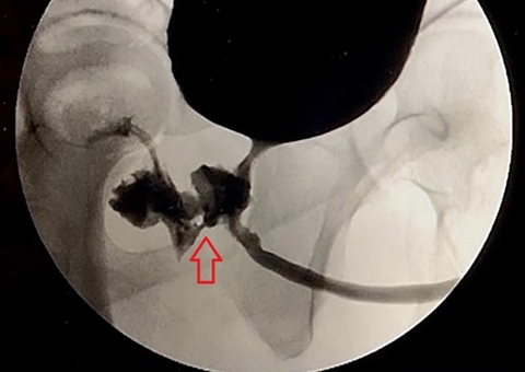 Condição rara faz homem passar 2 anos ejaculando pelo ânus e defecando pelo pênis