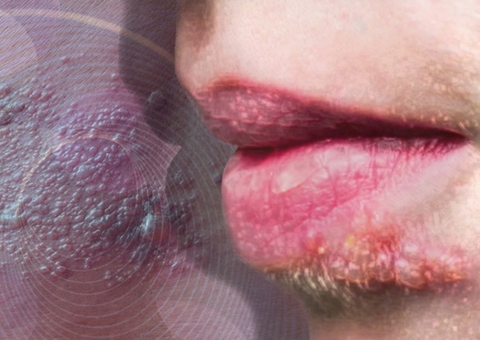 Entenda como acontece a transmissão do herpes labial