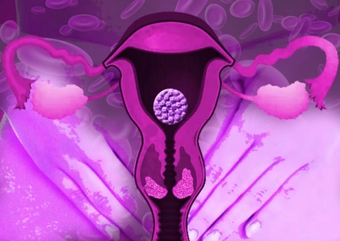 Câncer de colo do útero é o 3º que mais mata mulheres; saiba como se prevenir