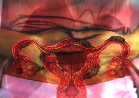 Até 40% das mulheres com endometriose têm dificuldades para engravidar