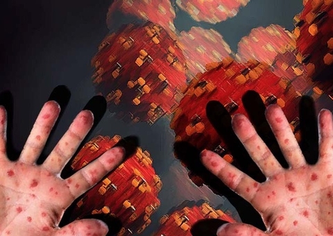 Sarampo tem taxa de transmissão maior que Covid-19 no Brasil