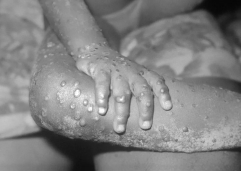 Entenda a diferença entre varíola humana e varíola dos macacos