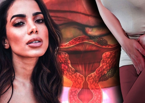 Endometriose: entenda sintomas e tratamento da doença de Anitta
