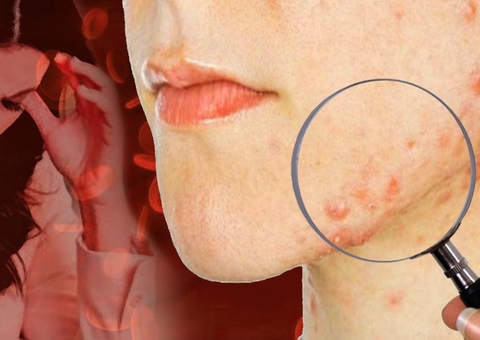 De dermatite a acne: entenda a relação do estresse e as reações na pele