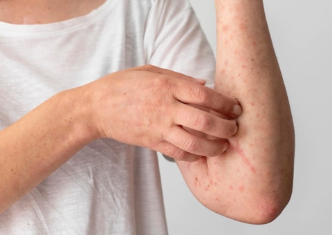 Confundidas com espinhas, lesões dificultam identificação da varíola dos macacos