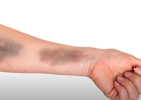 Entenda causas das manchas roxas no corpo e quando é grave