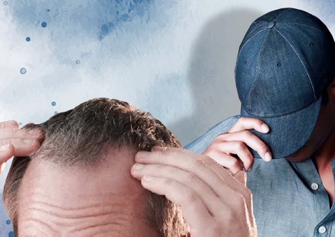 Uso de boné, genética ou estresse? Entenda causas da calvície